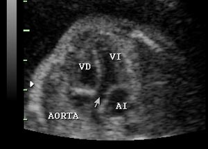 aorta