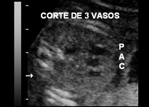 tres