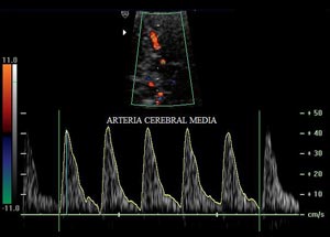 arteria