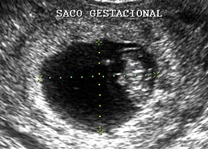 Saco Gestacional